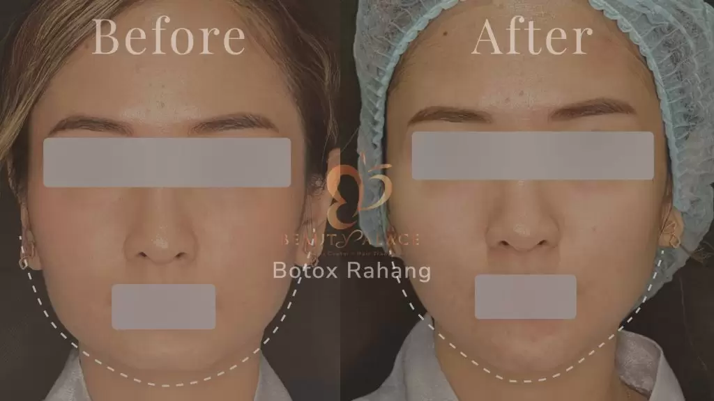 Before After Botox Rahang