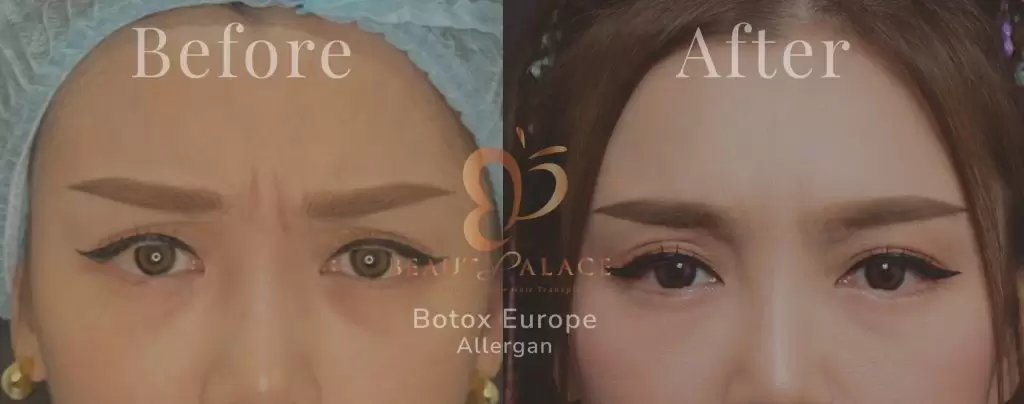 Before After Botox Tengah Alis