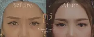 Before After Botox Tengah Alis