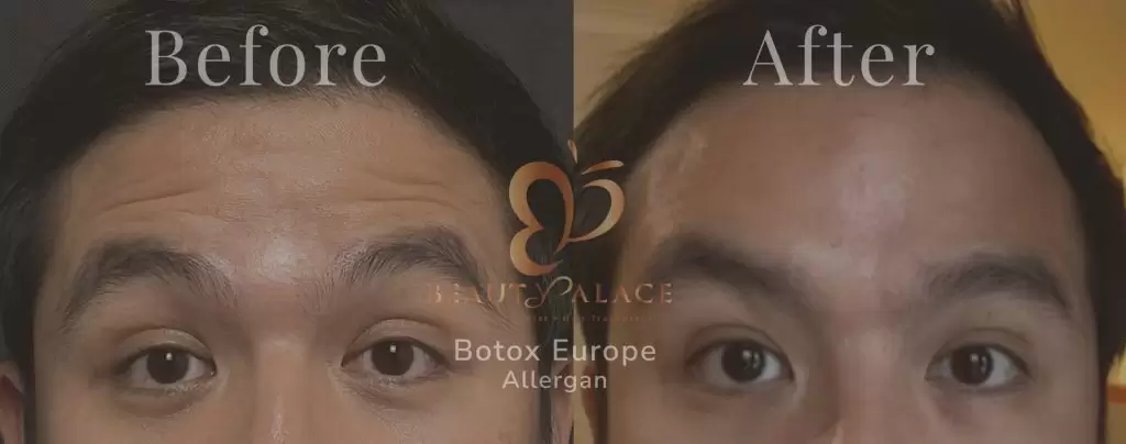 Before After Botox Dahi
