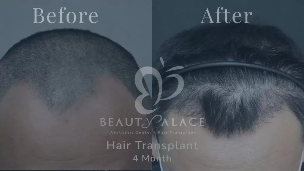 Before After Hair Transplant Beauty Palace Clinic Jakarta