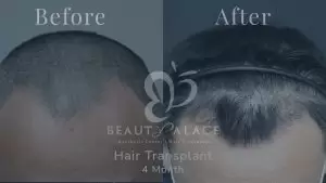 Before After Hair Transplant Beauty Palace Clinic Jakarta