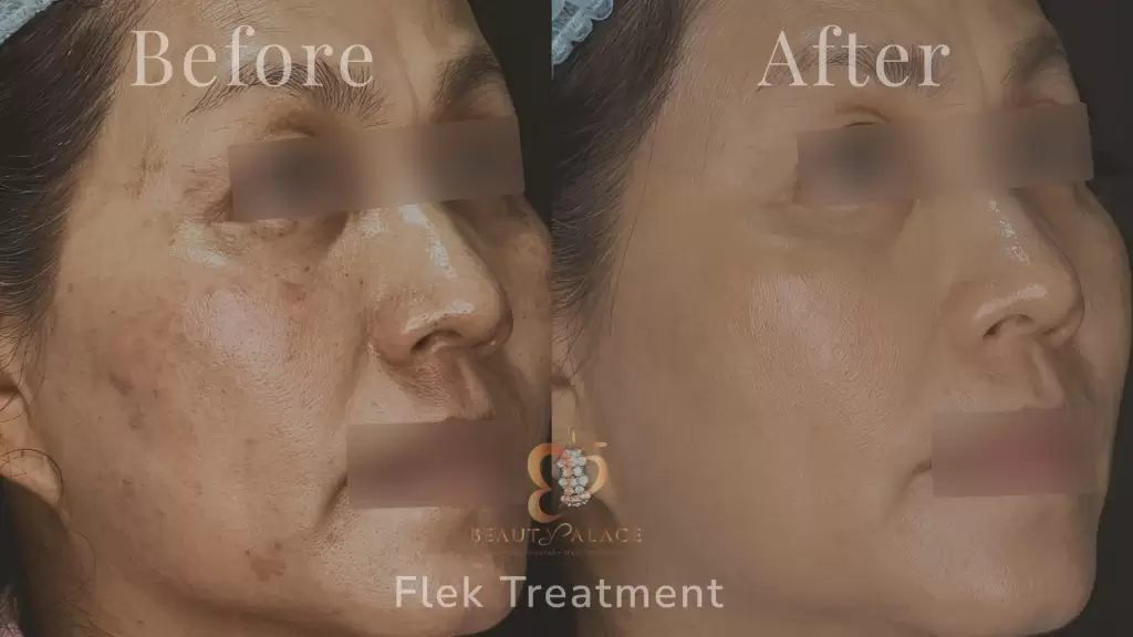 Before After Pico Laser Flek Treatment