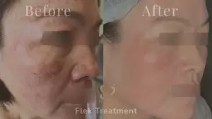 Before After Pico Flek Treatment 2