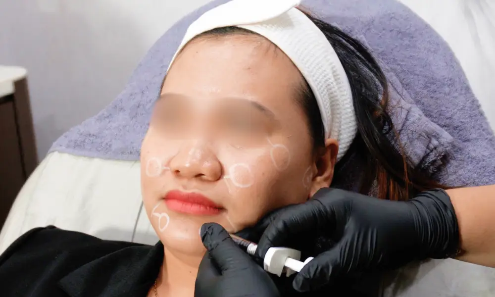 Profhilo 100% Hyaluronic Acid untuk Anti Aging