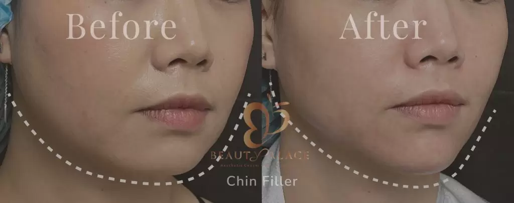 Chin Filler