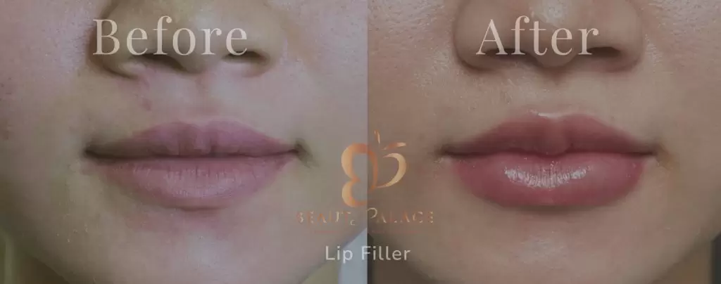 filler bibir