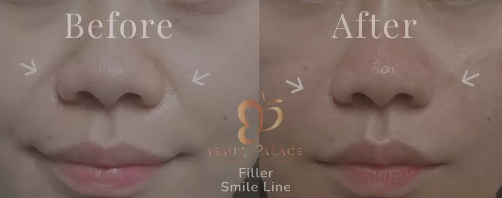 filler smile line