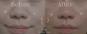 filler smile line