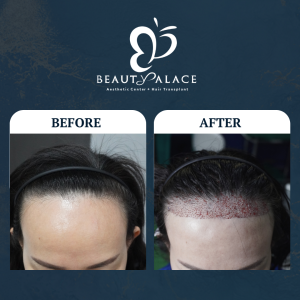 Before After Hair Transplant Untuk Wanita
