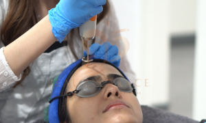Proses Perawatan Laser Kulit