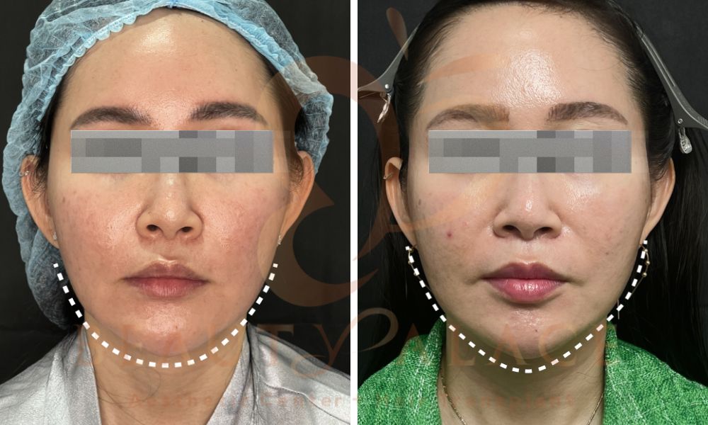 Before After Sofwave
