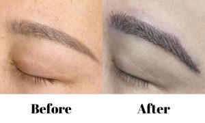 Eyebrow Transplant Before After