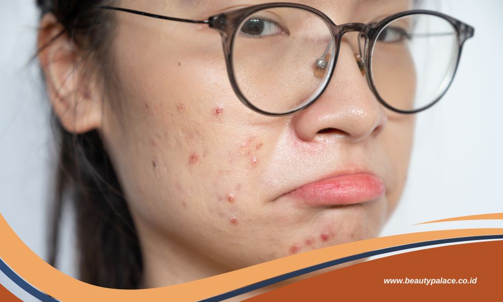 7 Cara Mengatasi Jerawat dengan Benar