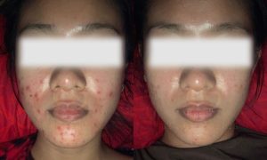 Result 1x Acne aWay