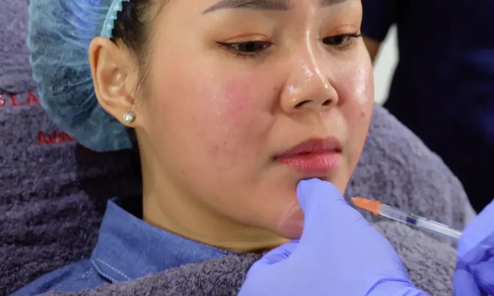 Filler Dagu Beauty Palace