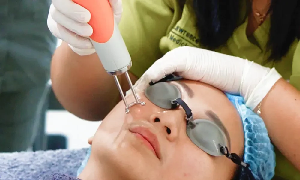 Pico Laser Flek Treatment
