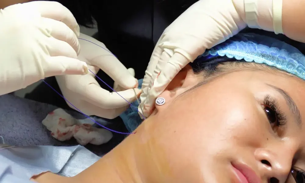 Thread Lift / Tanam Benang